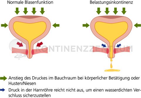 Belastungsinkontinenz 