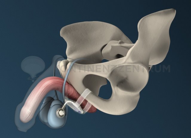 Schliessmuskelprothese - ATOMS Implantat 