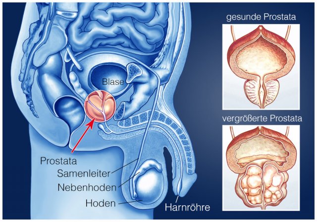 Nach Prostata-Operation: Impotenz?