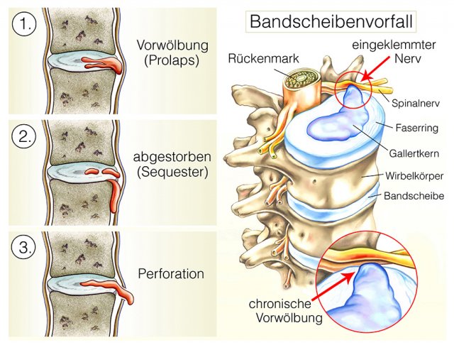 Bandscheibenvorfall – Schematische Darstellung