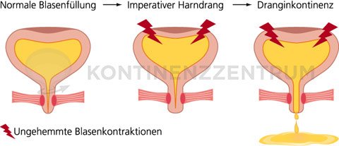 Dranginkontinenz