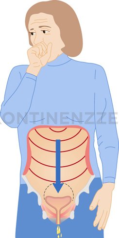 Grafik hustende Frau mit Urinabgang - Darstellung der Belastungsinkontinenz