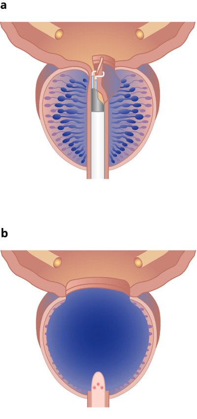 Prostata Operation Schema: TURP-transurethrale Resektion der Prostata