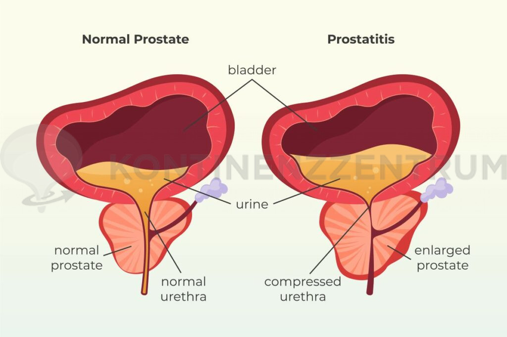 Wie Lange Dauert Eine Prostataentzündung www.kontinenzzentrum.ch