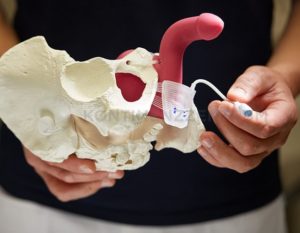 Schliessmuskelprothese - ATOMS Implantat